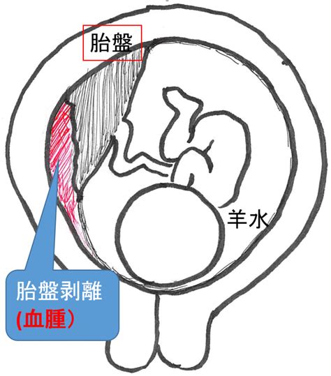 胎盤剝離後期